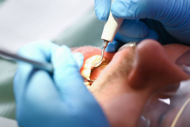 Best Emergency Root Canal Treatment in Aurora, SD